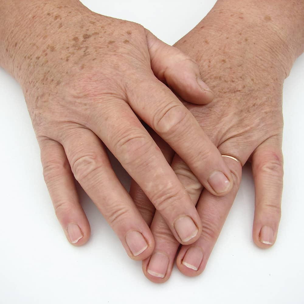 Épilation Laser à Lyon