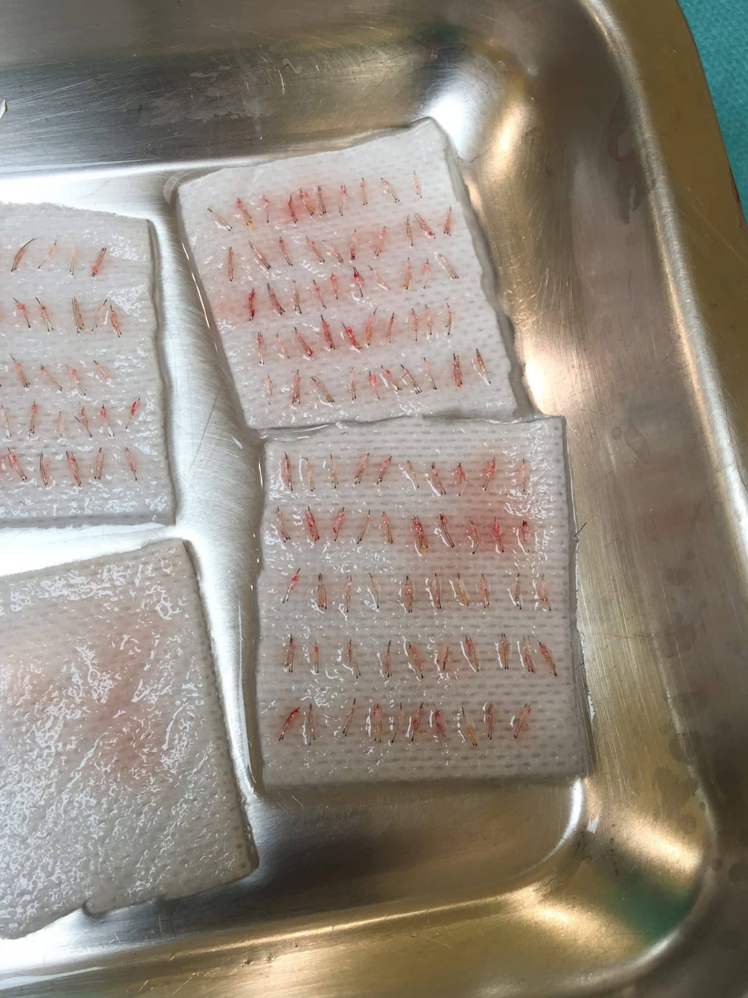 greffe de cheveux lyon - dr costa