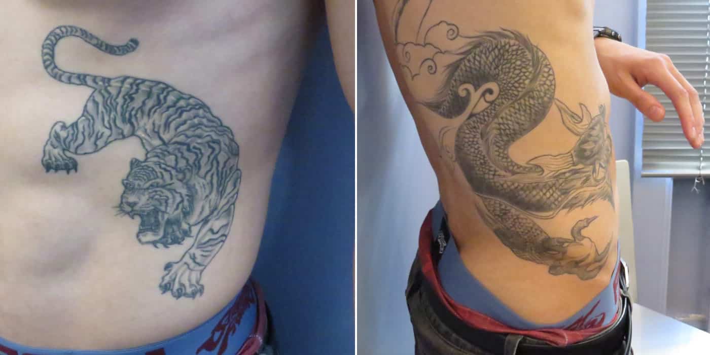 Détatouage en cours