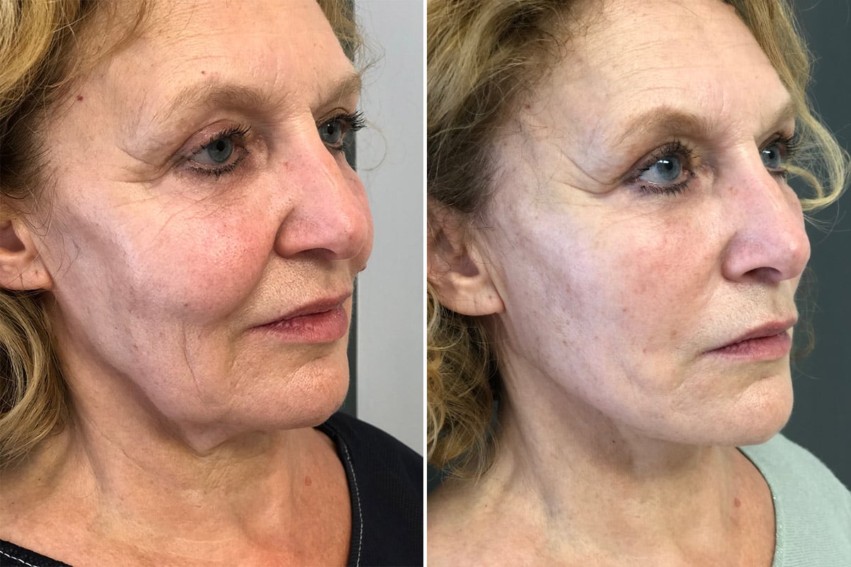 Fils tenseurs permanents Infinite Thread résultats