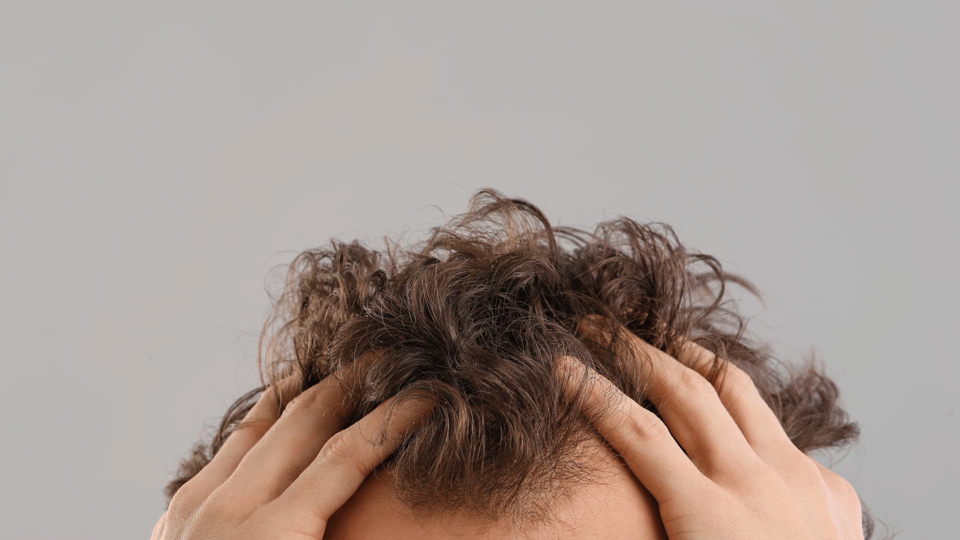 Nouvel Horizon Capillaire : Optez pour la Greffe FUE