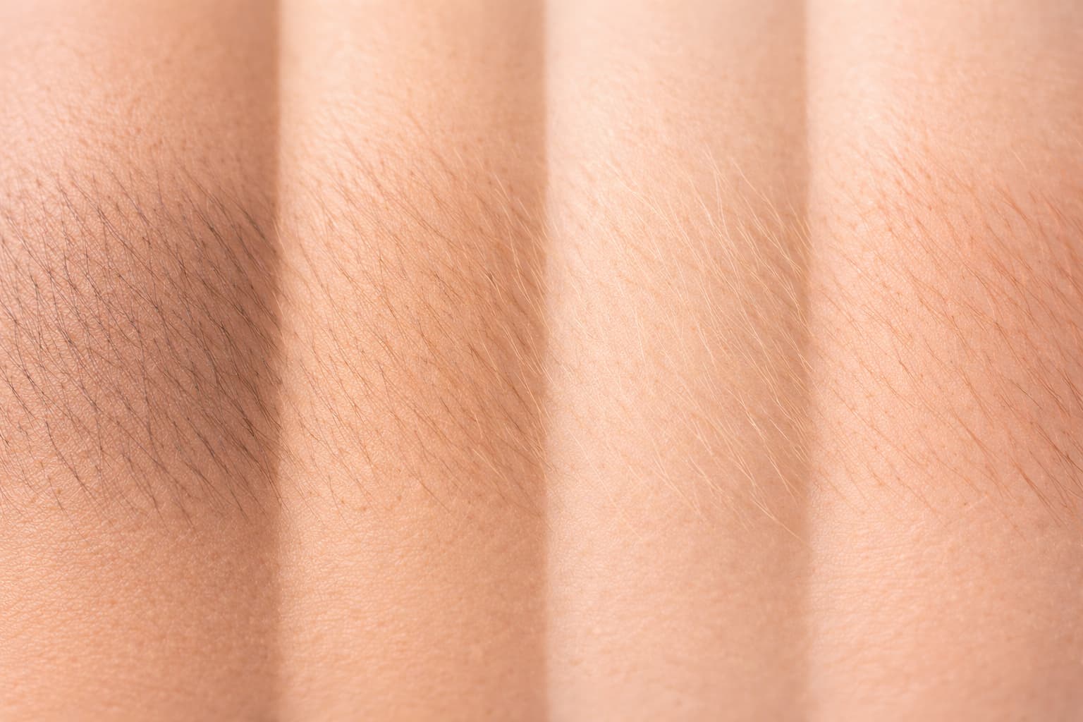 epilation laser poils blonds et roux