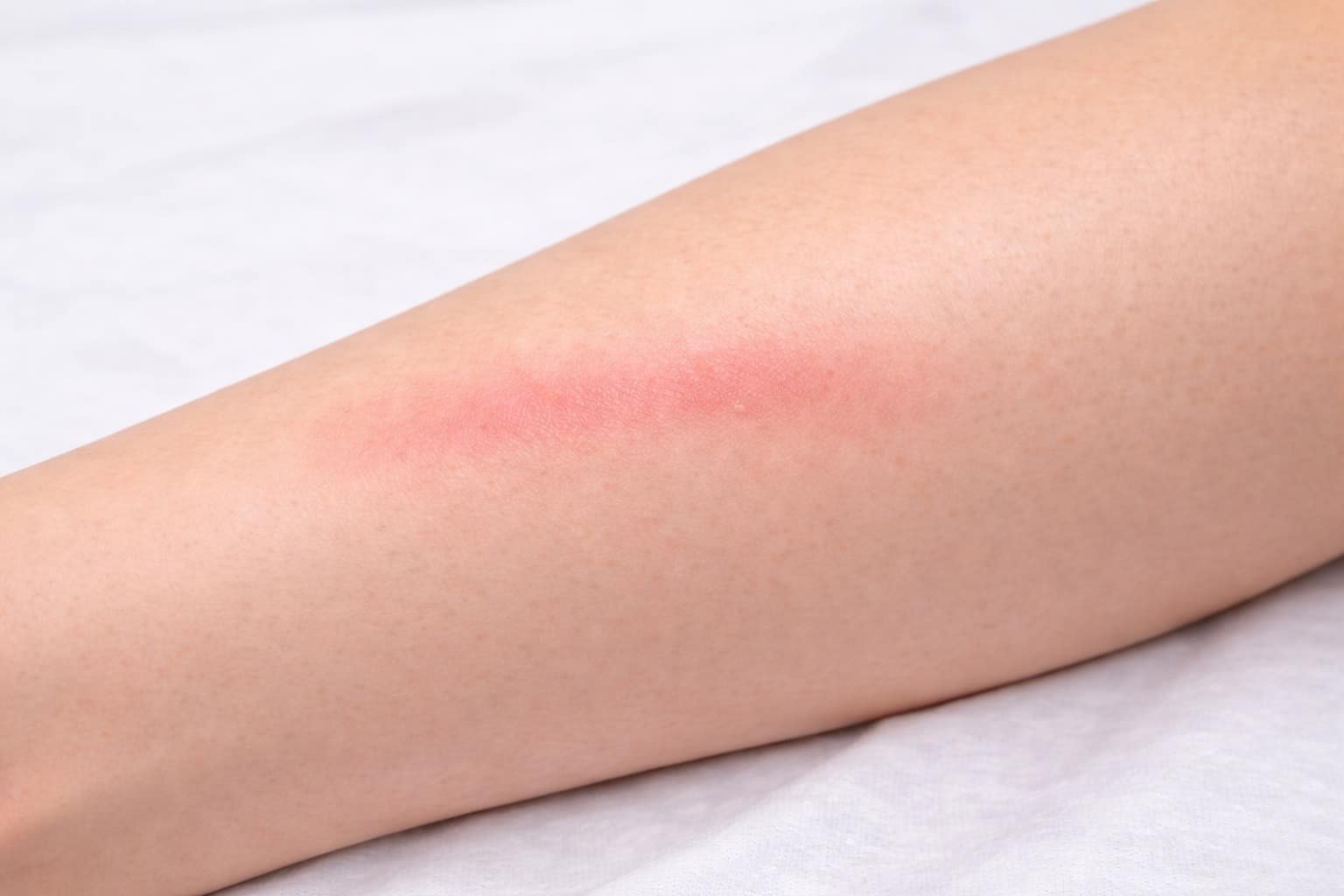 irritation de la peau apres epilation laser