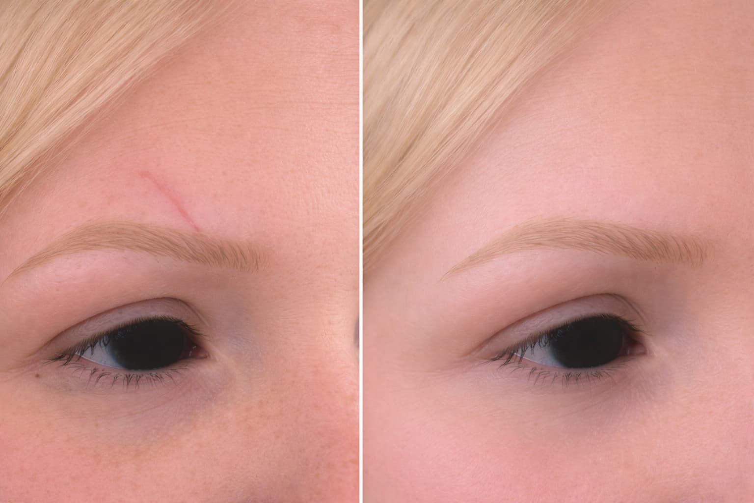 Comparaison avant-après du sourcil