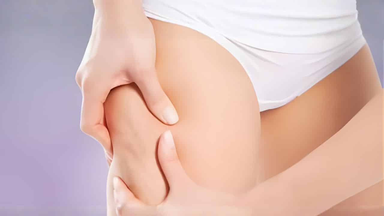 cellulite cryolipolyse lyon