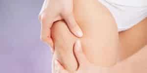cellulite et cryolopolyse