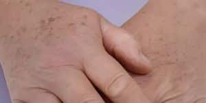 lentigos - dr costa - lyon