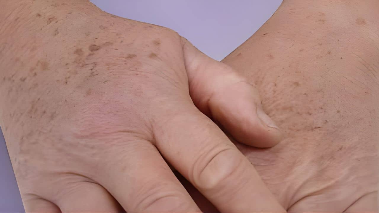 traitement lentigos lyon