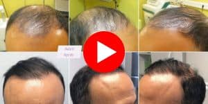 videos greffe cheveux - dr costa - lyon